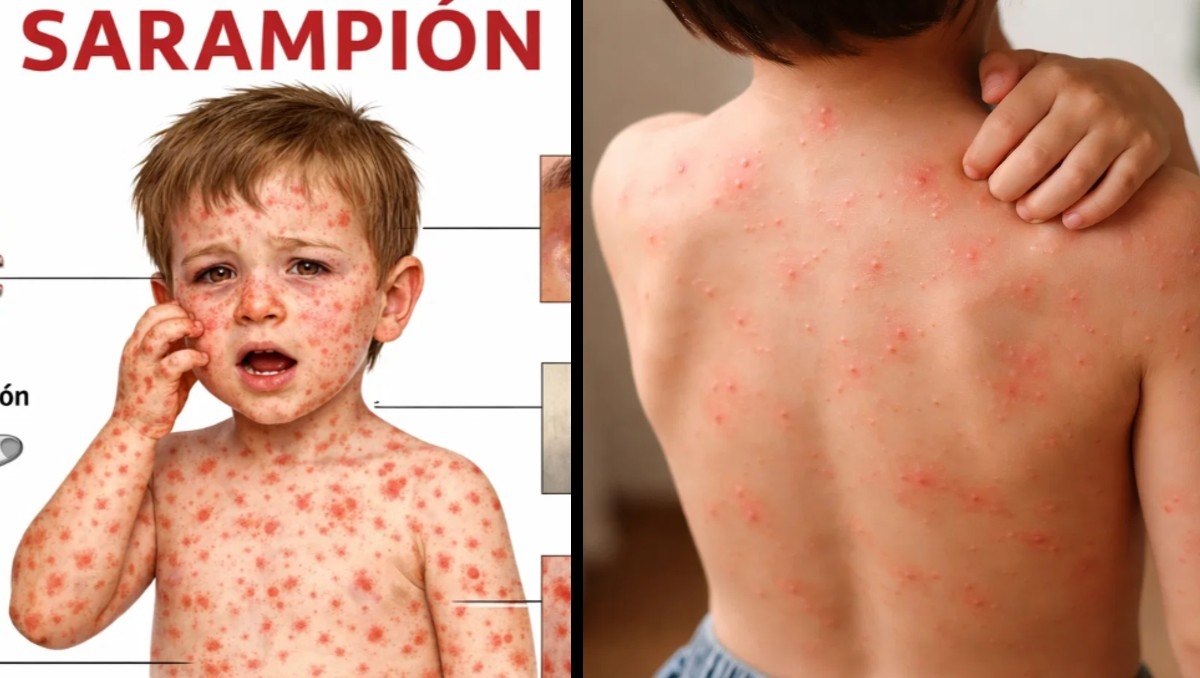 sintomas clave diferenciar sarampion alergia